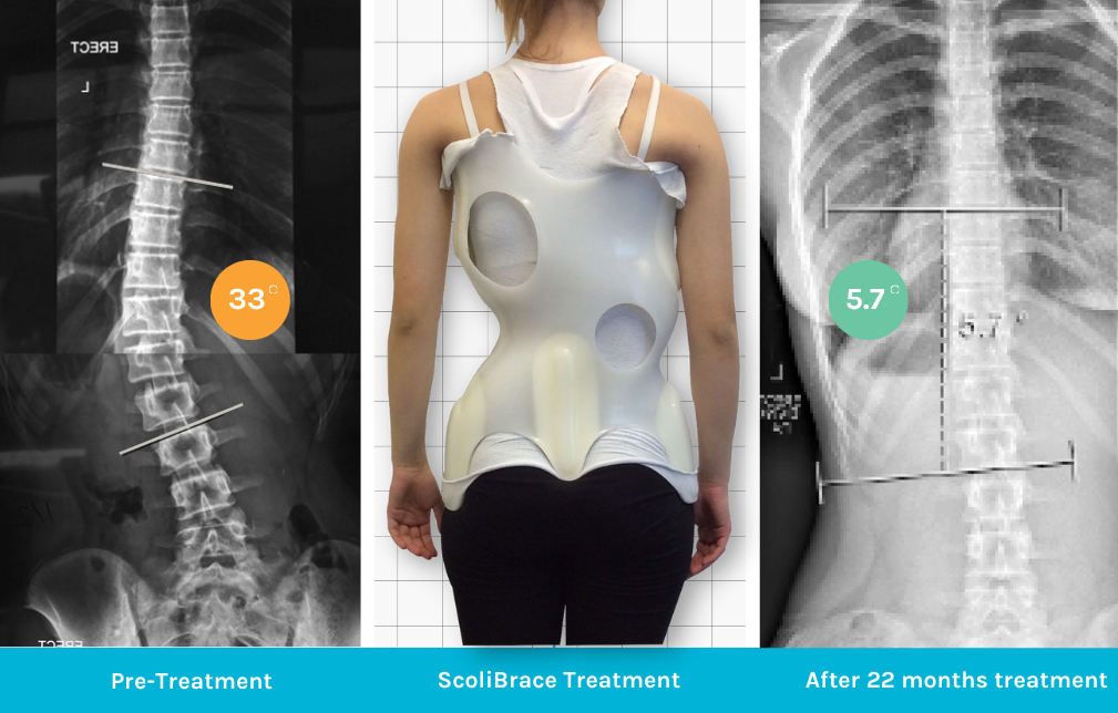 A person with Scoliosis Treatment with ScoliBrace at Connected Chiropractic in Calgary